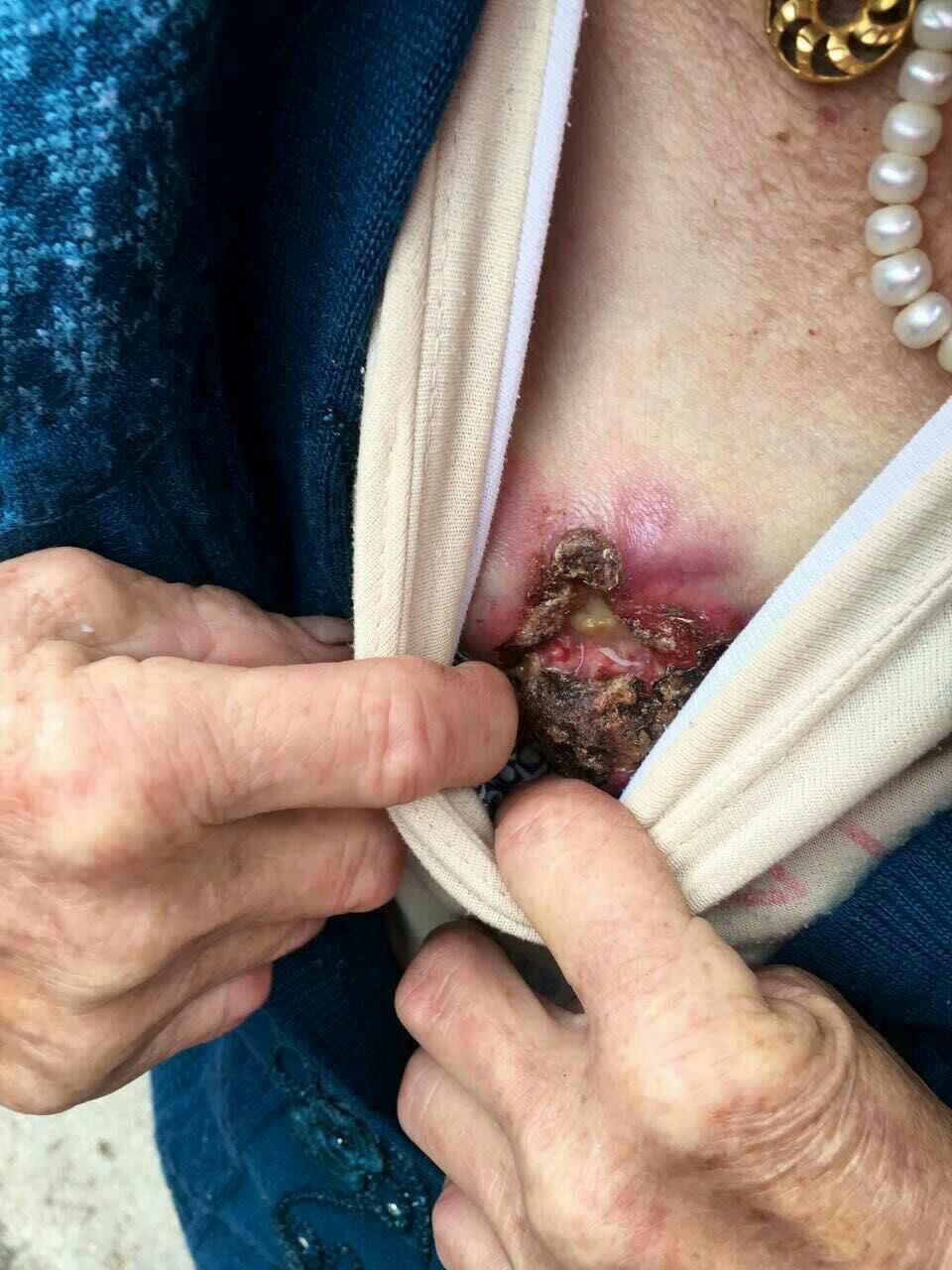 乳腺癌患者用肽一天就已经好转